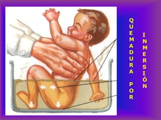 Q
U
E
M
A
D
U
R
A
P
O
R
I
N
M
E
R
S
I
Ó
N
 