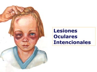 Lesiones
Oculares
Intencionales
 