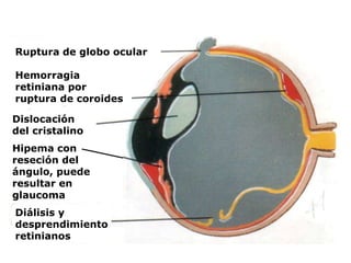 Ruptura de globo ocular
Hemorragia
retiniana por
ruptura de coroides
Dislocación
del cristalino
Hipema con
reseción del
ángulo, puede
resultar en
glaucoma
Diálisis y
desprendimiento
retinianos
 