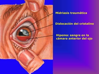 Midriasis traumática
Dislocación del cristalino
Hipema: sangre en la
cámara anterior del ojo
 