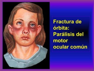 Fractura de
órbita:
Parálisis del
motor
ocular común
 