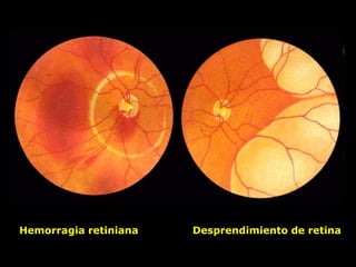 Hemorragia retiniana Desprendimiento de retina
 