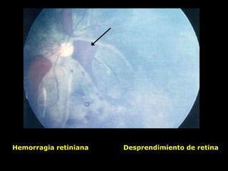 Hemorragia retiniana Desprendimiento de retina
 