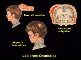 Tirón de cabellos
Alopecia
traumática
Hematoma
subgaleal
XXX
Lesiones Craneales
 