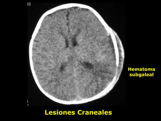 XXX
Lesiones Craneales
Hematoma
subgaleal
 