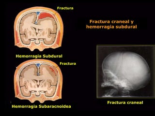Fractura craneal y
hemorragia subdural
Fractura
Hemorragia Subdural
Fractura
Hemorragia Subaracnoidea
Fractura craneal
 