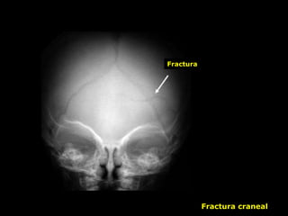 Fractura craneal
Fractura
 