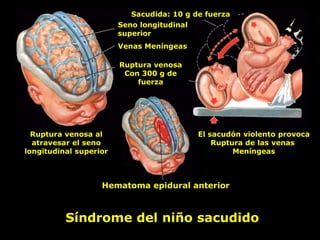 Síndrome del niño sacudido
Sacudida: 10 g de fuerza
Seno longitudinal
superior
Venas Meníngeas
Ruptura venosa
Con 300 g de
fuerza
Ruptura venosa al
atravesar el seno
longitudinal superior
xxx
El sacudón violento provoca
Ruptura de las venas
Meníngeas
Hematoma epidural anterior
 