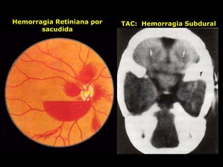 Hemorragia Retiniana por
sacudida
TAC: Hemorragia Subdural
 