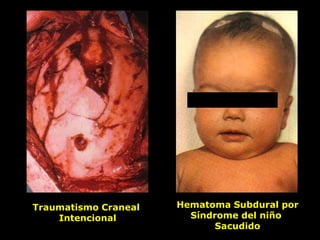 Traumatismo Craneal
Intencional
Hematoma Subdural por
Síndrome del niño
Sacudido
 