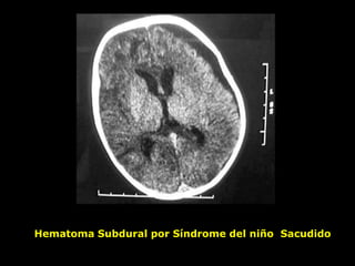 Hematoma Subdural por Síndrome del niño Sacudido
 