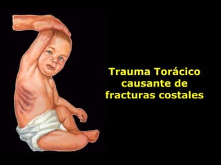 Trauma Torácico
causante de
fracturas costales
 