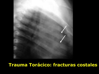Trauma Torácico: fracturas costales
 