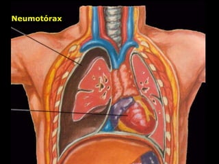 Neumotórax
Neumotórax
 