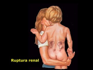 Ruptura renal
 