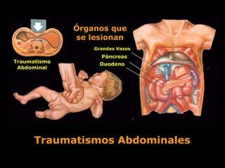 Traumatismo
Abdominal
Órganos que
se lesionan
Grandes Vasos
Páncreas
Duodeno
Traumatismos Abdominales
 
