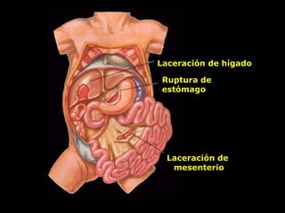 Laceración de hígado
Ruptura de
estómago
Laceración de
mesenterio
 