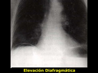 Elevación Diafragmática
 