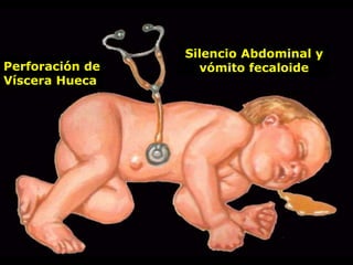 Perforación de
Víscera Hueca
Silencio Abdominal y
vómito fecaloide
 