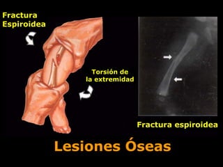 Fractura
Espiroidea
Torsión de
la extremidad
Fractura espiroidea
Lesiones Óseas
 