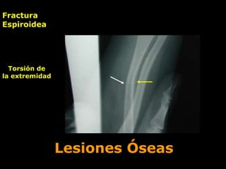Fractura
Espiroidea
Torsión de
la extremidad
Lesiones Óseas
 
