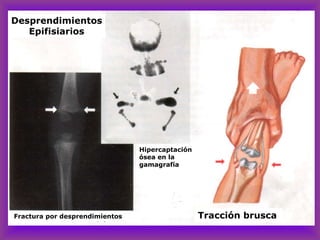 Desprendimientos
Epifisiarios
Hipercaptación
ósea en la
gamagrafía
Fractura por desprendimientos Tracción brusca
 