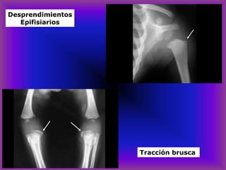 Desprendimientos
Epifisiarios
Tracción brusca
 