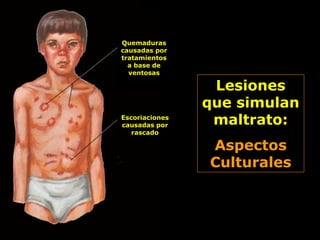 Quemaduras
causadas por
tratamientos
a base de
ventosas
Escoriaciones
causadas por
rascado
Lesiones
que simulan
maltrato:
Aspectos
Culturales
 