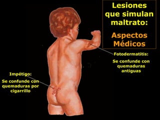 Lesiones
que simulan
maltrato:
Aspectos
Médicos
Fotodermatitis:
Se confunde con
quemaduras
antiguas
Impétigo:
Se confunde con
quemaduras por
cigarrillo
 