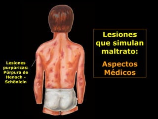 Lesiones
que simulan
maltrato:
Aspectos
Médicos
Lesiones
purpúricas:
Púrpura de
Henoch -
Schönlein
 