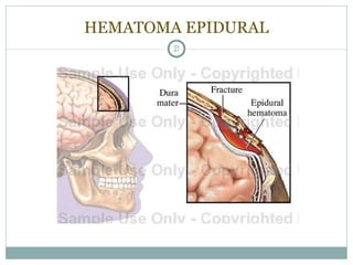 HEMATOMA EPIDURAL 