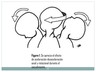 Figura 1 . Se aprecia el efecto de aceleración-desaceleración axial y rotacional durante el sacudimiento.   