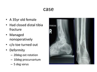 case
• A 35yr old female
• Had closed distal tibia
fracture
• Managed
nonoperatively
• c/o toe turned out
• Deformity
– 20deg ext rotation
– 10deg procurvartum
– 5 deg varus
 