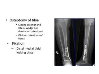 • Osteotomy of tibia
• Closing anterior and
lateral wedge and
derotation osteotomy
• Oblique osteotomy of
fibula
• Fixation
– Distal medial tibial
locking plate
 