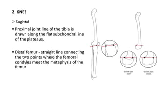 2. KNEE
Sagittal
 Proximal joint line of the tibia is
drawn along the flat subchondral line
of the plateaus.
 Distal femur - straight line connecting
the two points where the femoral
condyles meet the metaphysis of the
femur.
 