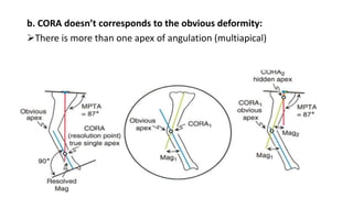 b. CORA doesn’t corresponds to the obvious deformity:
There is more than one apex of angulation (multiapical)
 