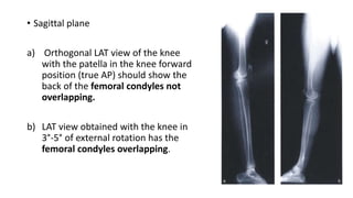 • Sagittal plane
a) Orthogonal LAT view of the knee
with the patella in the knee forward
position (true AP) should show the
back of the femoral condyles not
overlapping.
b) LAT view obtained with the knee in
3°-5° of external rotation has the
femoral condyles overlapping.
 