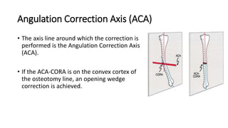 Angulation Correction Axis (ACA)
• The axis line around which the correction is
performed is the Angulation Correction Axis
(ACA).
• If the ACA-CORA is on the convex cortex of
the osteotomy line, an opening wedge
correction is achieved.
 
