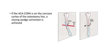 • If the ACA-CORA is on the concave
cortex of the osteotomy line, a
closing wedge correction is
achieved
 