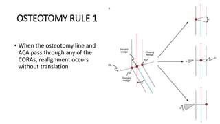 OSTEOTOMY RULE 1
• When the osteotomy line and
ACA pass through any of the
CORAs, realignment occurs
without translation
 