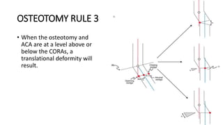 OSTEOTOMY RULE 3
• When the osteotomy and
ACA are at a level above or
below the CORAs, a
translational deformity will
result.
 
