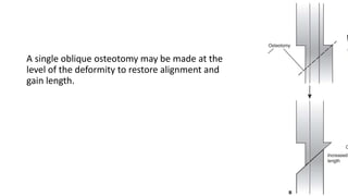 A single oblique osteotomy may be made at the
level of the deformity to restore alignment and
gain length.
 
