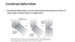Combined deformities
• Combined deformities are characterized by the presence of two or
more types of deformity in a single bone.
 