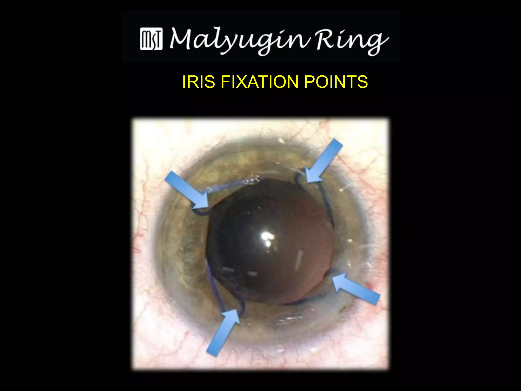 Surgical strategies for small pupils - Malyugin Ring | PPTX