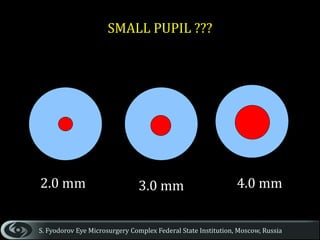 Surgical strategies for small pupils - Malyugin Ring | PPTX