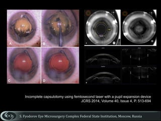 Surgical strategies for small pupils - Malyugin Ring | PPTX