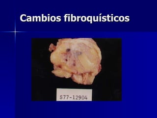 Cambios fibroquísticos  