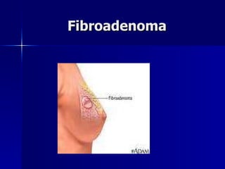 Fibroadenoma  