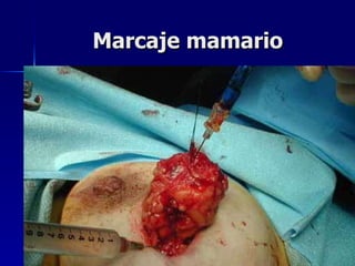 Marcaje mamario 