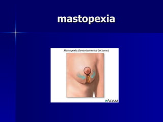 mastopexia 